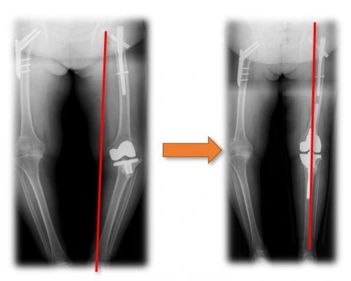 Small Acetabular Components Combined with Medial Protrusio Technique