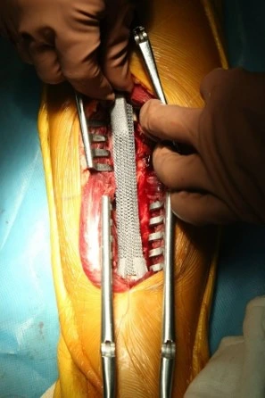 Small Acetabular Components Combined with Medial Protrusio Technique