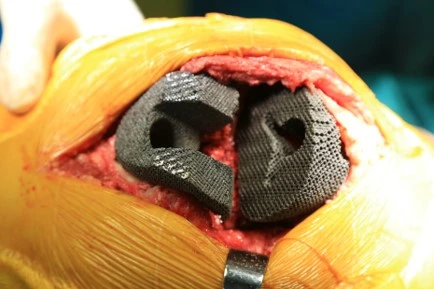 Small Acetabular Components Combined with Medial Protrusio Technique